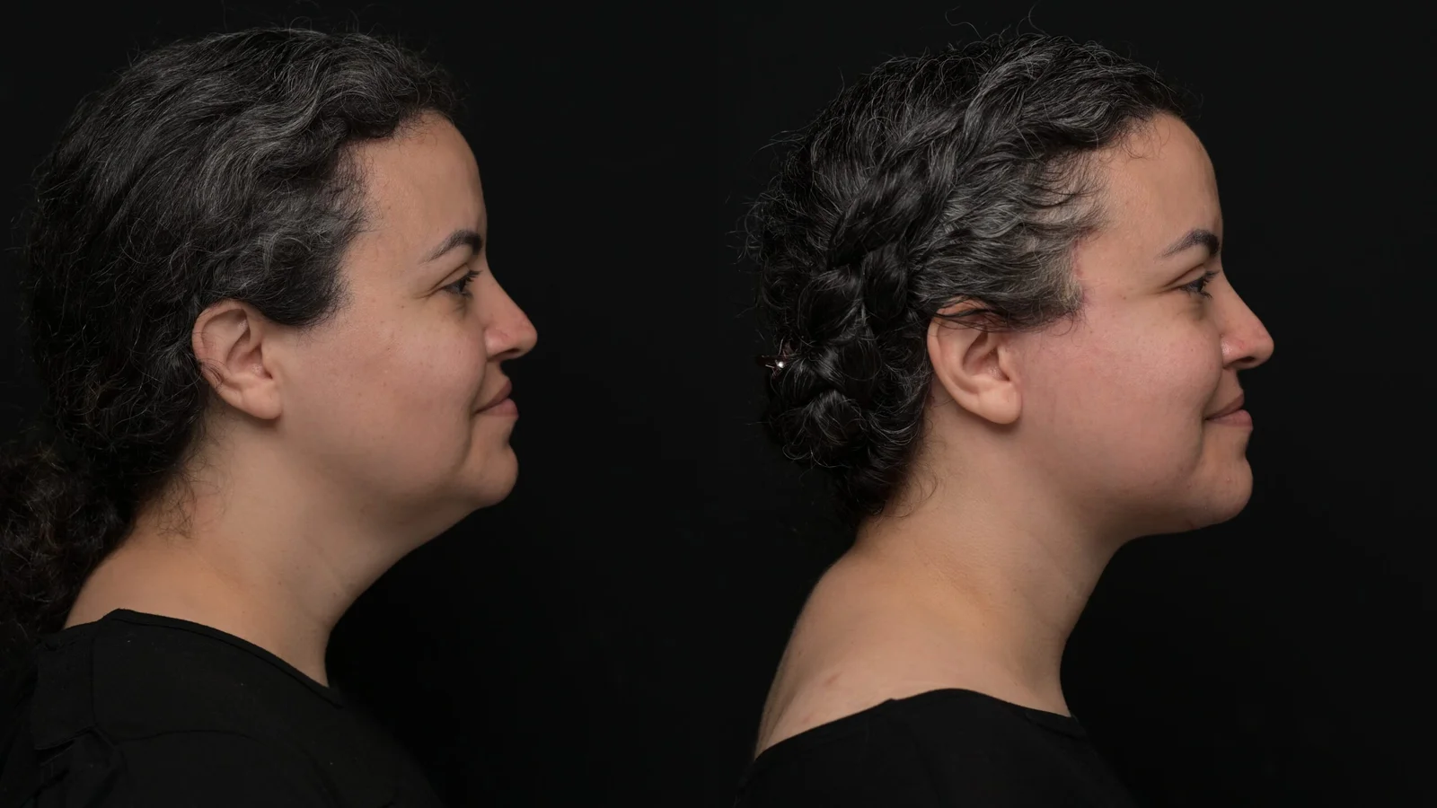 Before-and-after photograph, deep plane facelift and neck lift