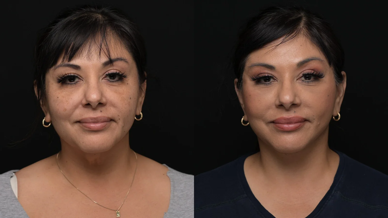 Before-and-after photograph, deep plane facelift and neck lift