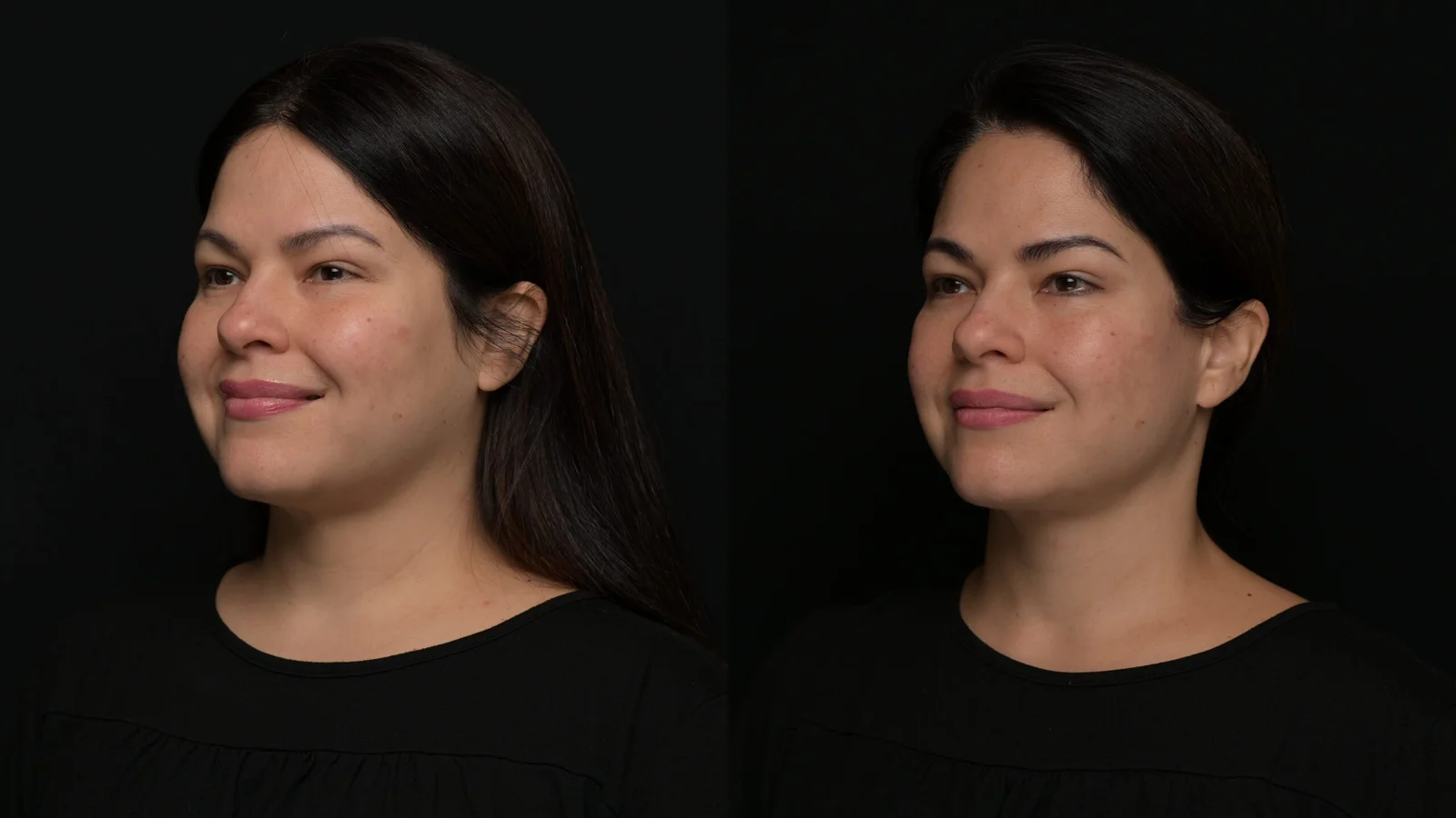 Before-and-after photograph, deep plane facelift and neck lift