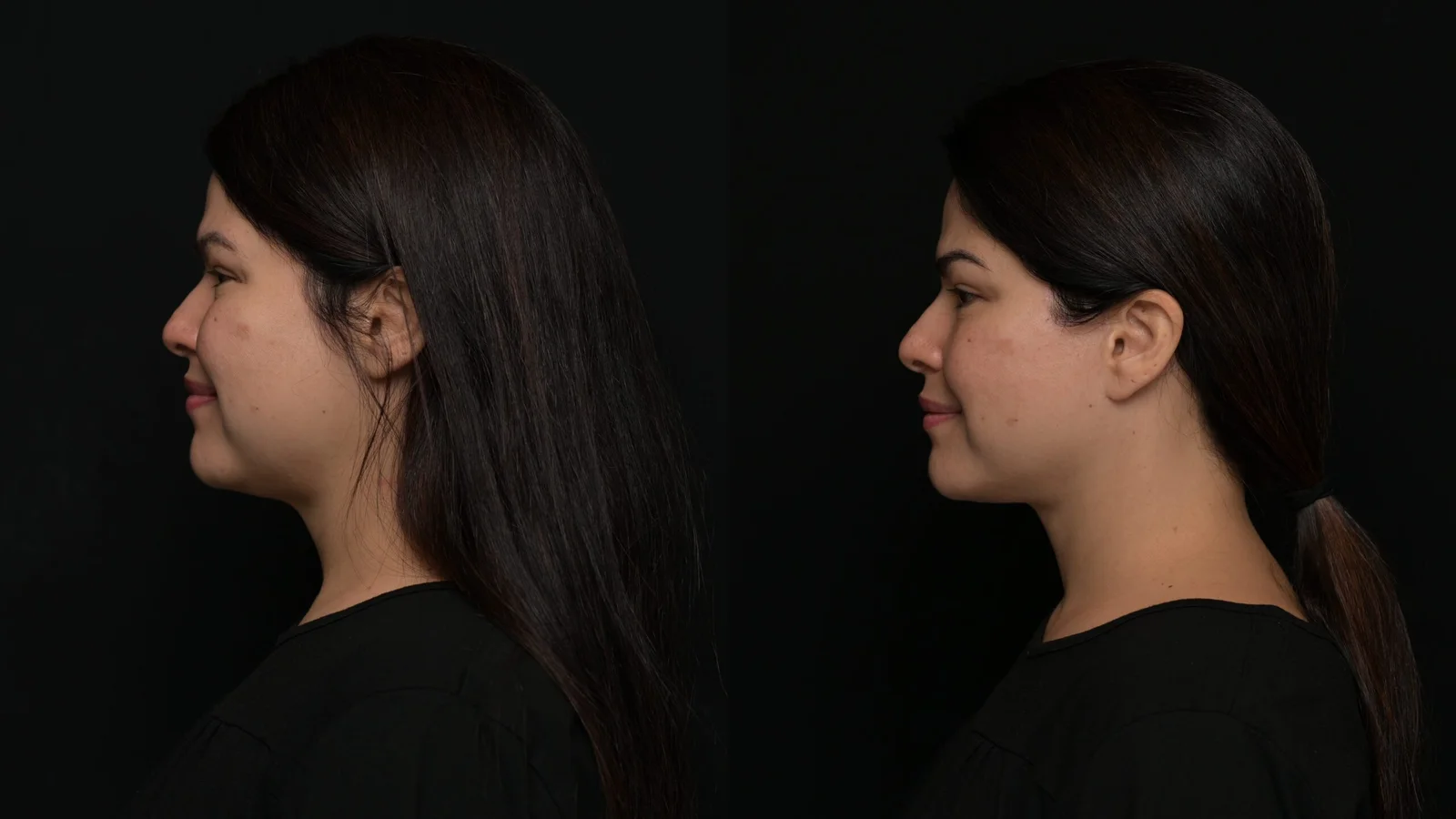 Before-and-after photograph, deep plane facelift and neck lift