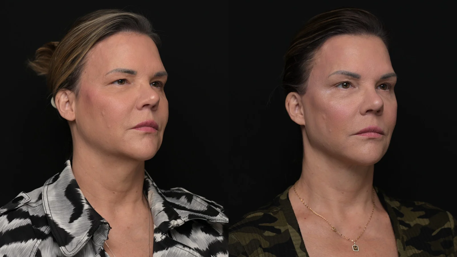 Before-and-after photograph, deep plane facelift and neck lift