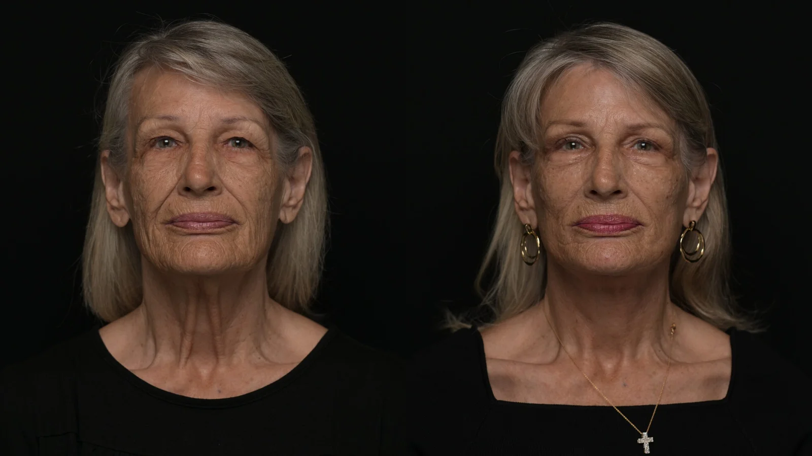 Before-and-after photograph, deep plane facelift and neck lift