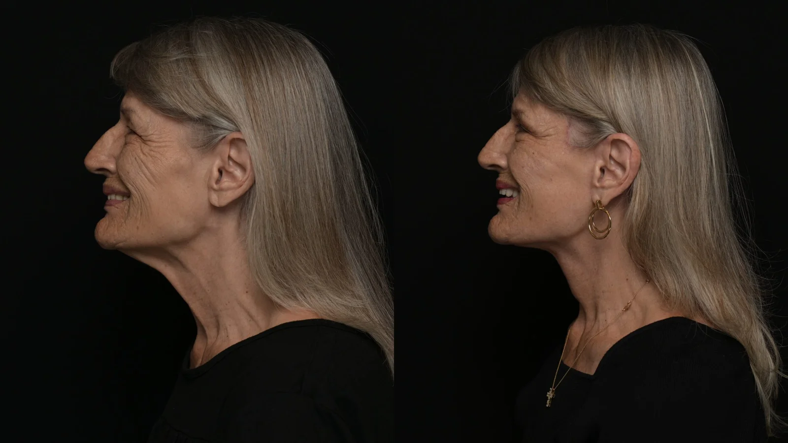Before-and-after photograph, deep plane facelift and neck lift