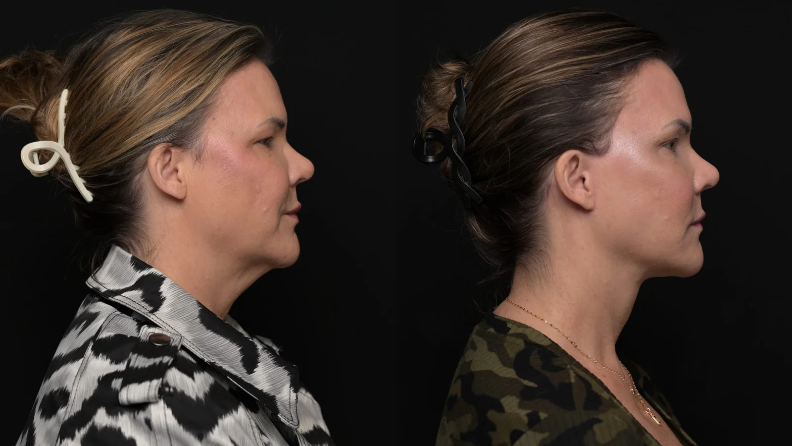 Before-and-after photograph, deep plane facelift and neck lift