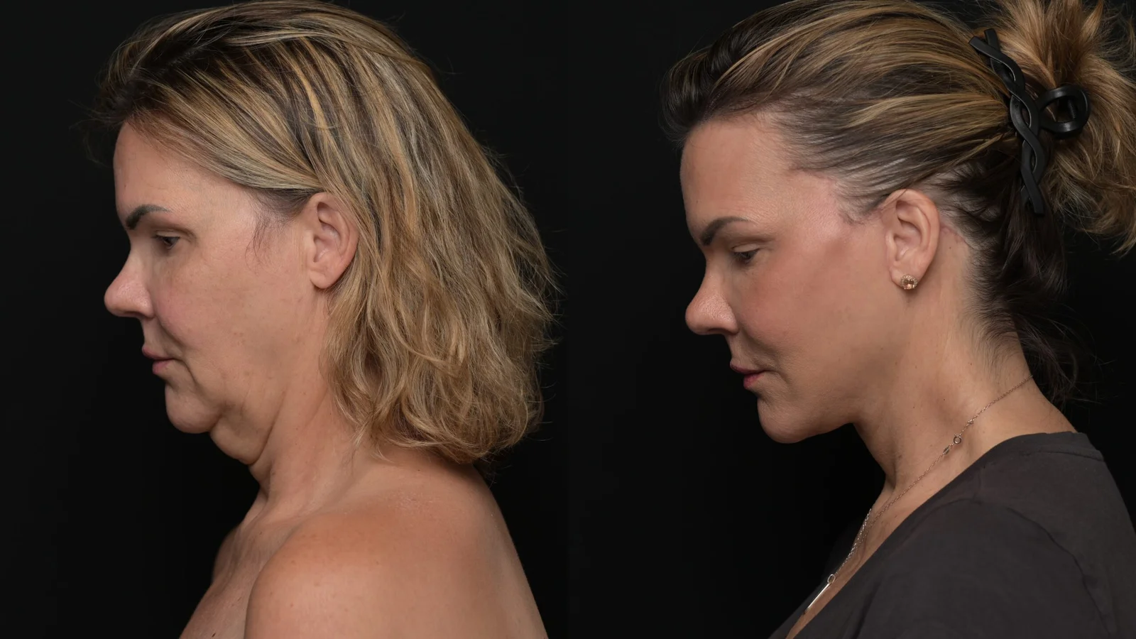 Before-and-after photograph, deep plane facelift and neck lift