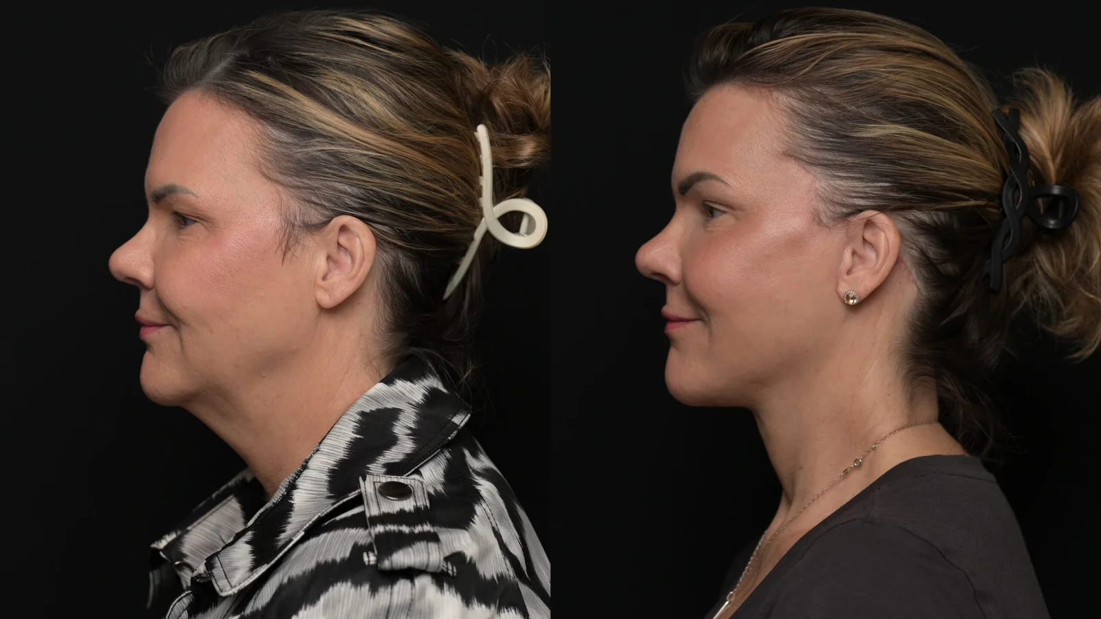 Before-and-after photograph, deep plane facelift and neck lift