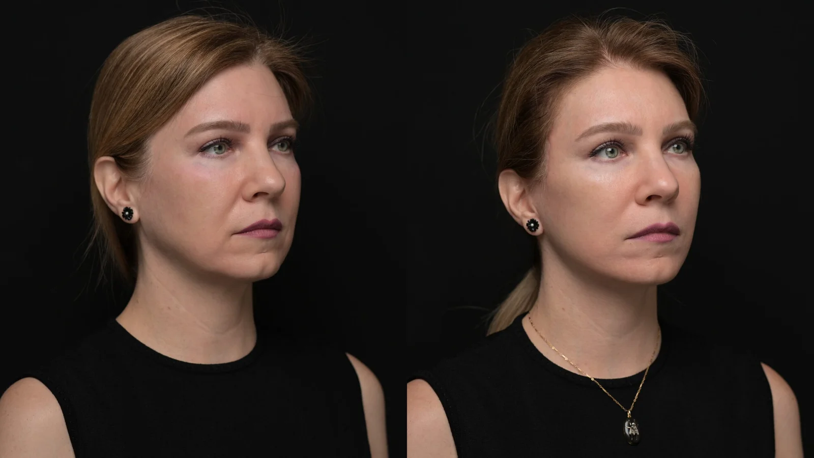 Before-and-after photograph, deep plane facelift and neck lift