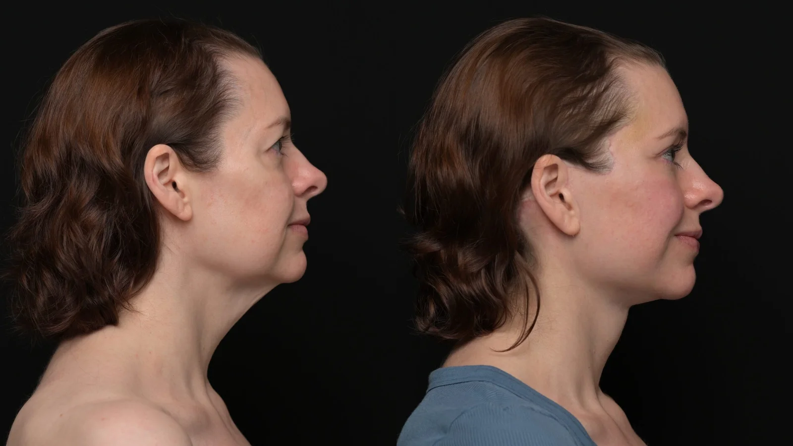 Before-and-after photograph, deep plane facelift and neck lift