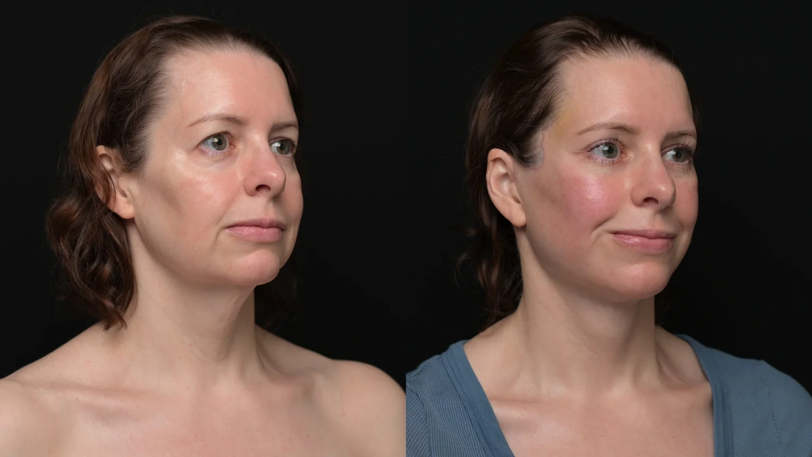 Before-and-after photograph, deep plane facelift and neck lift
