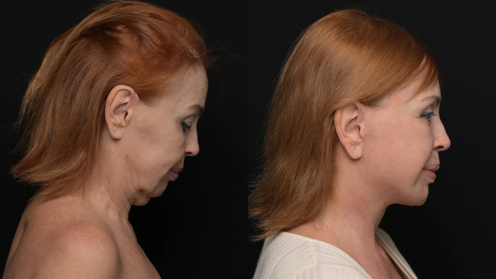Before-and-after photograph, deep plane facelift and neck lift