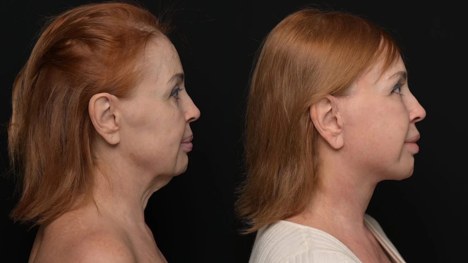Before-and-after photograph, deep plane facelift and neck lift