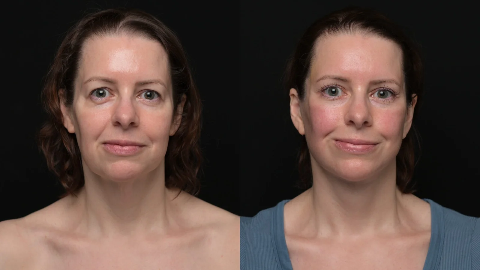 Before-and-after photograph, deep plane facelift and neck lift