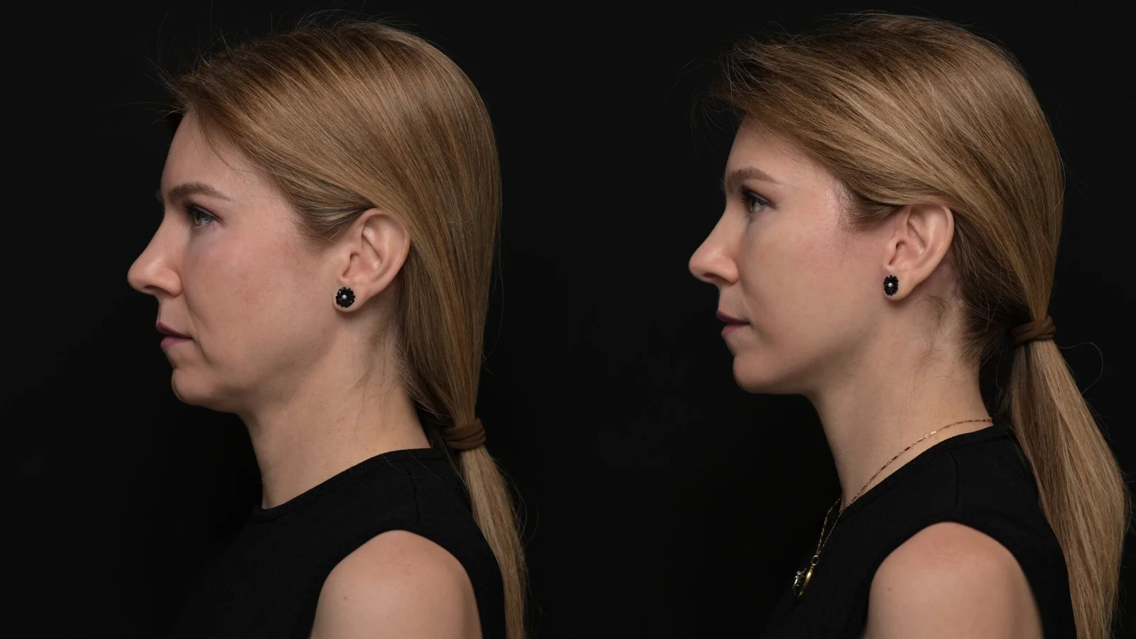 Before-and-after photograph, deep plane facelift and neck lift