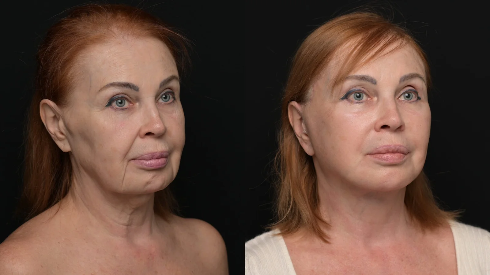 Before-and-after photograph, deep plane facelift and neck lift