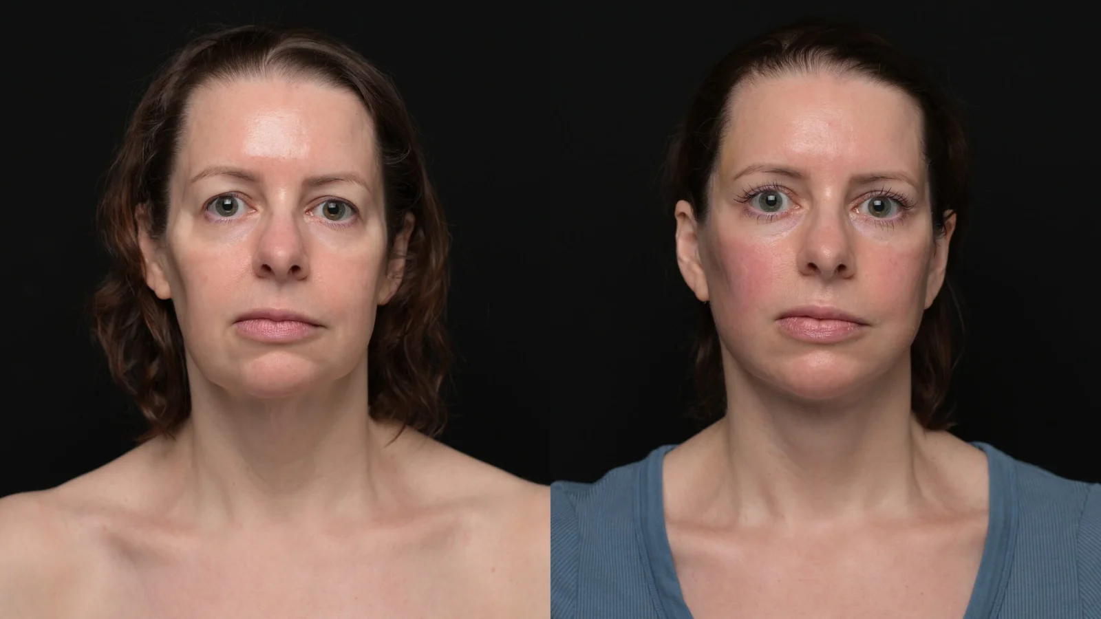 Before-and-after photograph, deep plane facelift and neck lift
