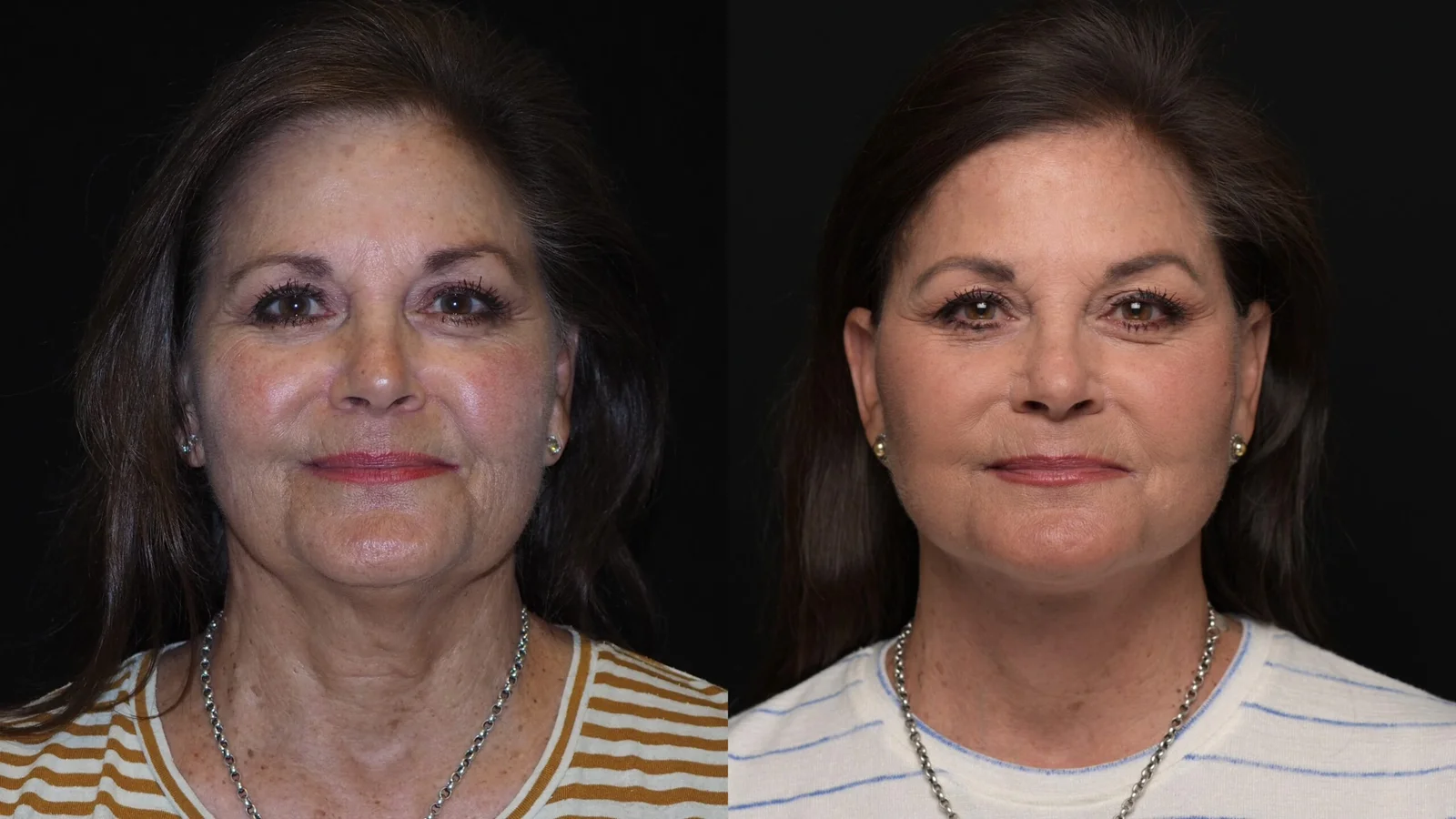 Before-and-after photograph, deep plane facelift and neck lift
