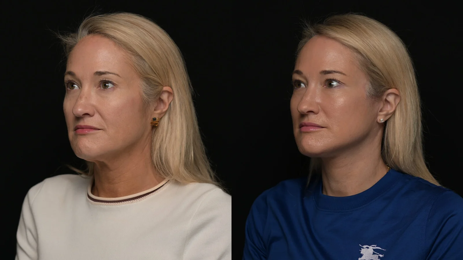 Before-and-after photograph, deep plane facelift and neck lift