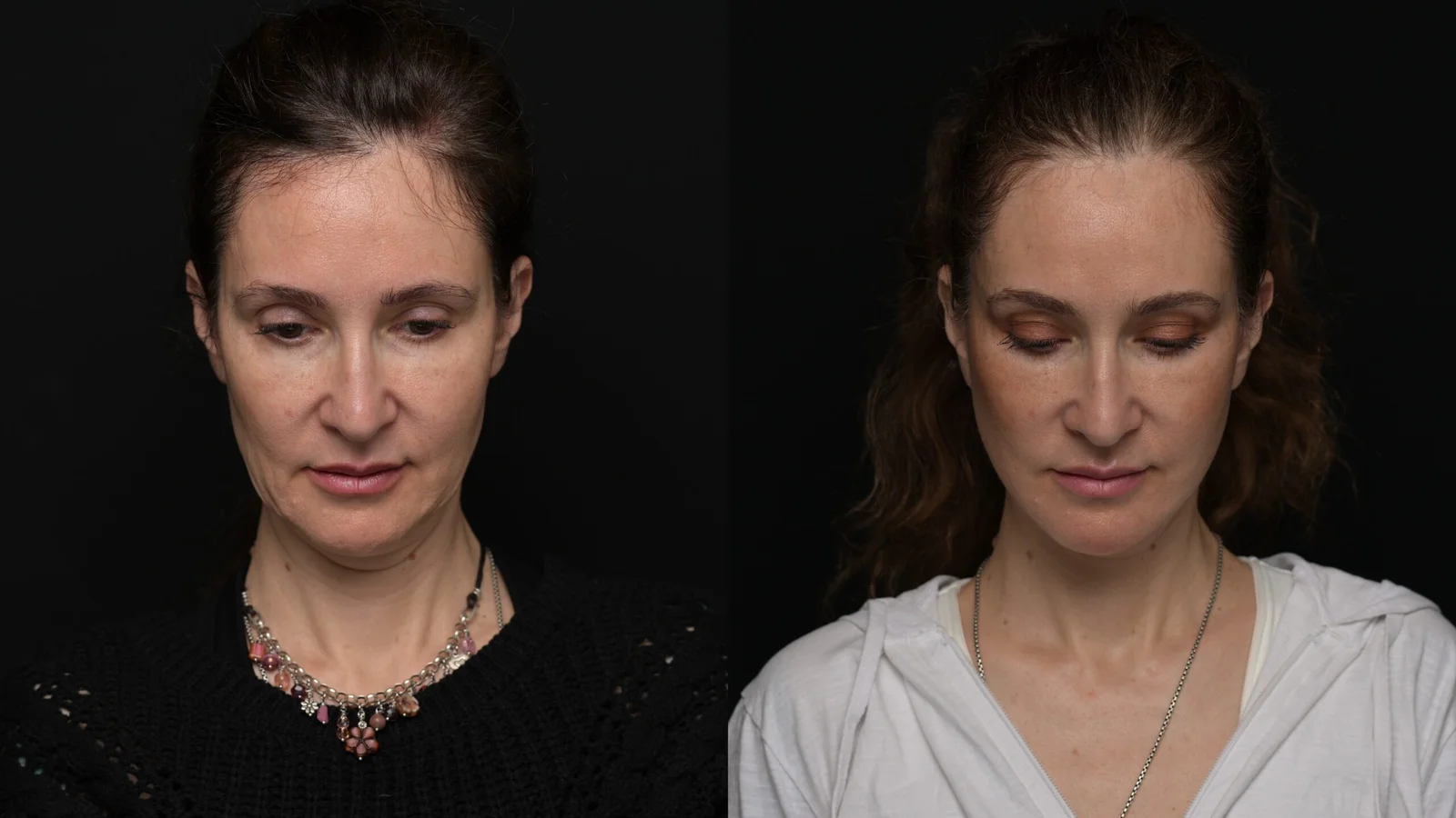 Before-and-after photograph, deep plane facelift and neck lift