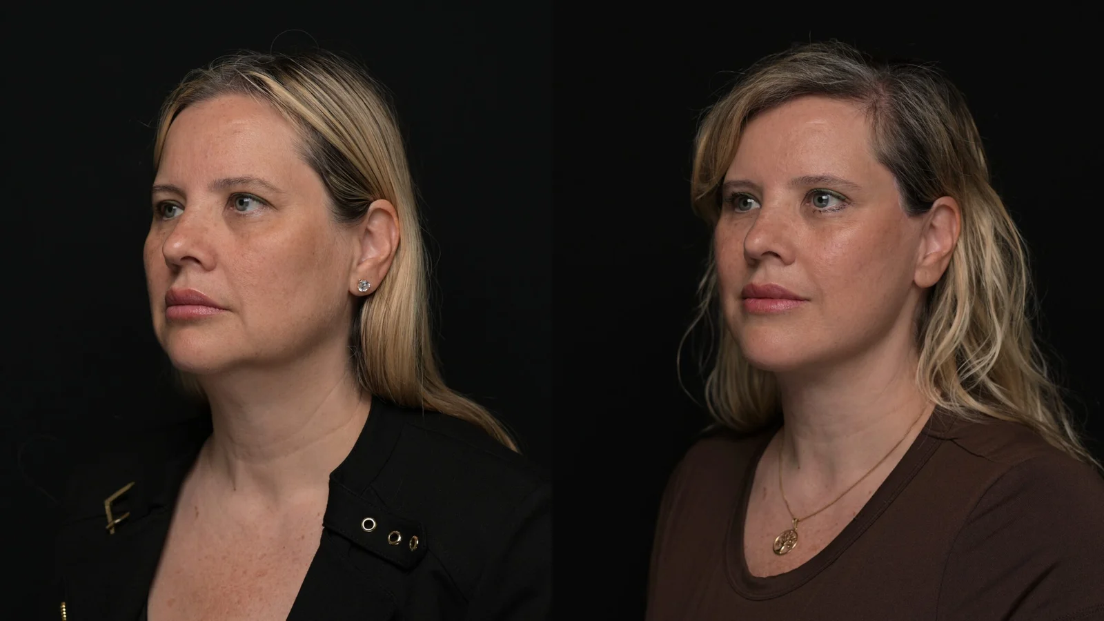 Before-and-after photograph, deep plane facelift and neck lift