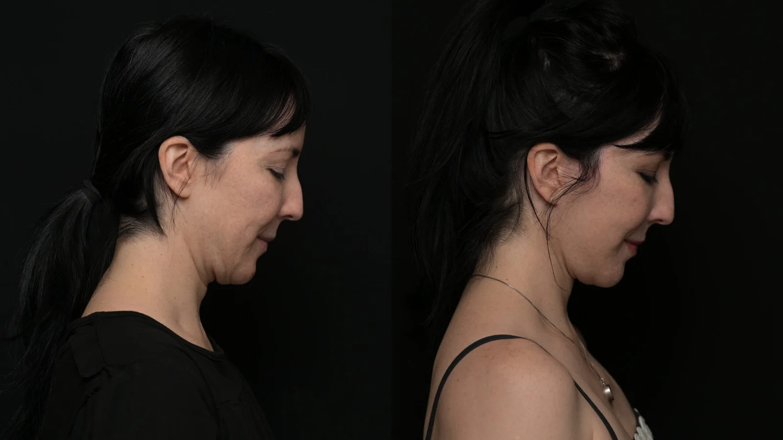 Before-and-after photograph, deep plane facelift and neck lift