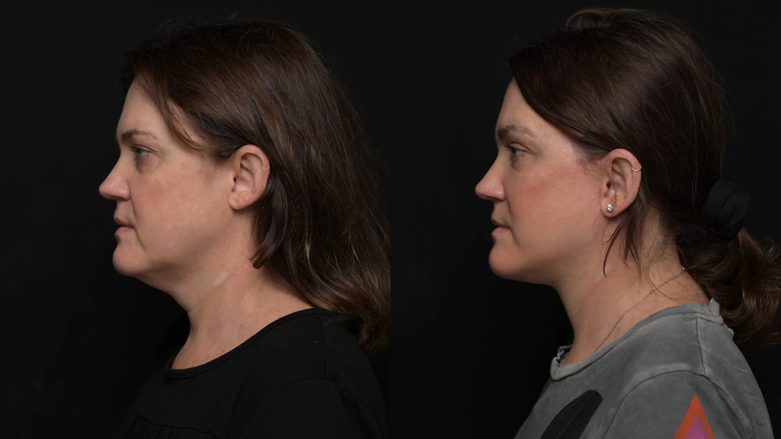 Before-and-after photograph, deep plane facelift and neck lift