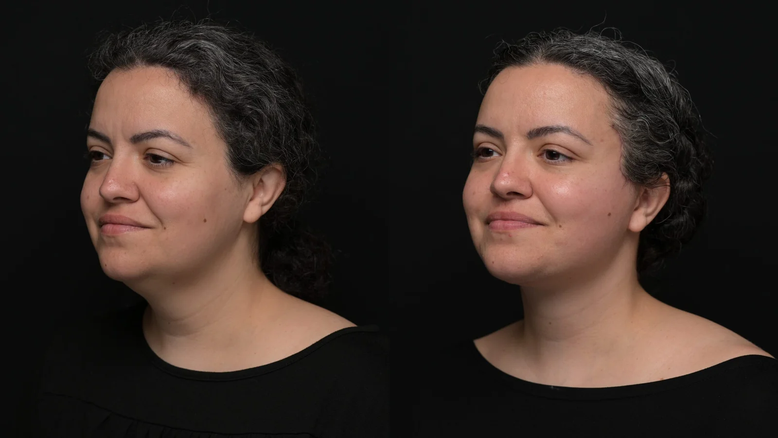 Before-and-after photograph, deep plane facelift and neck lift