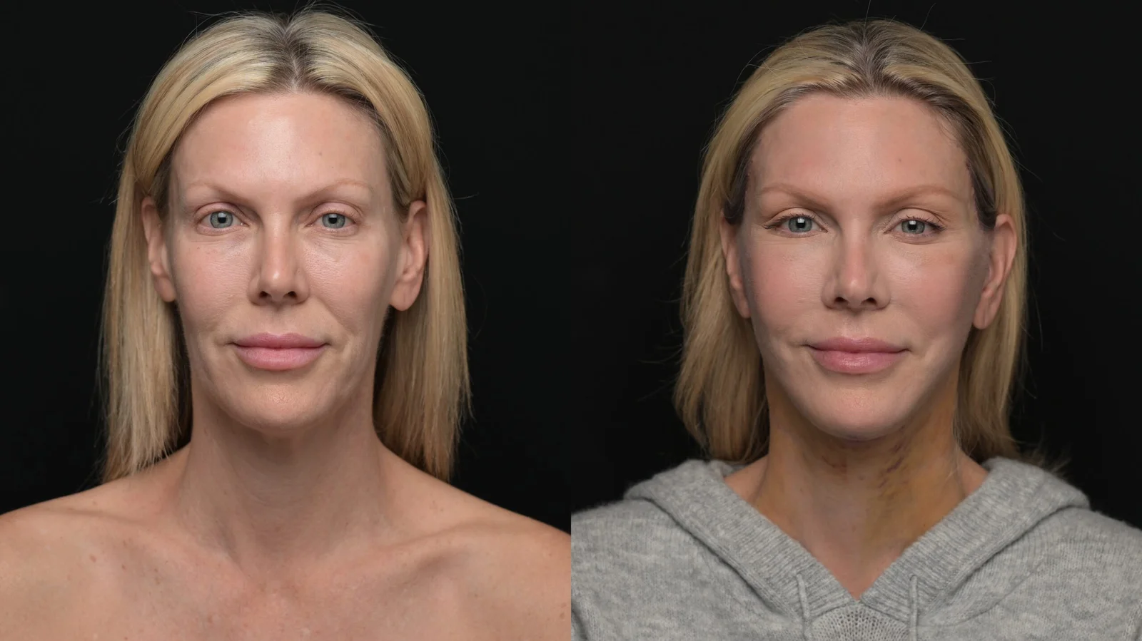 Before-and-after photograph, deep plane facelift and neck lift