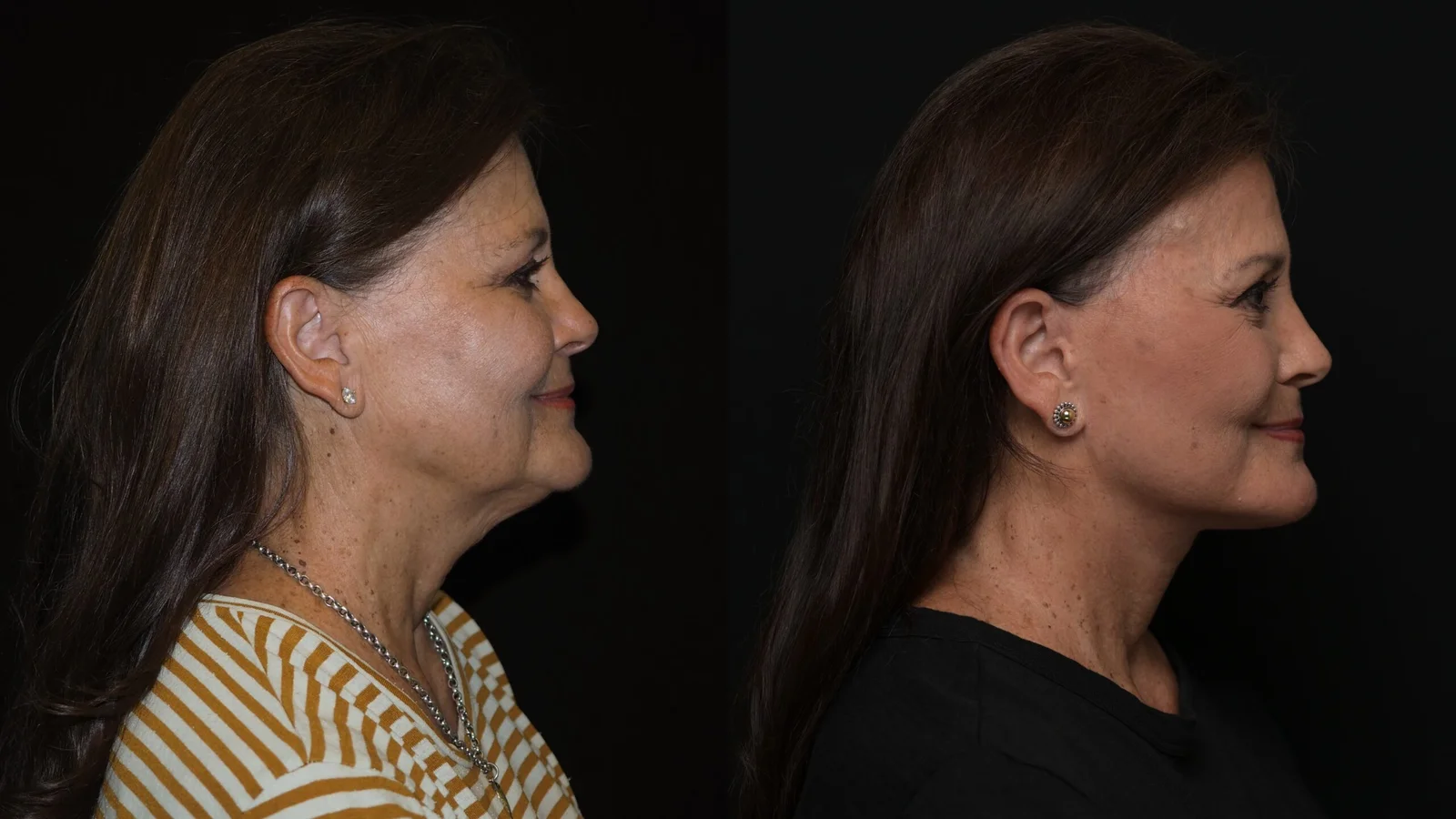 Before-and-after photograph, deep plane facelift and neck lift
