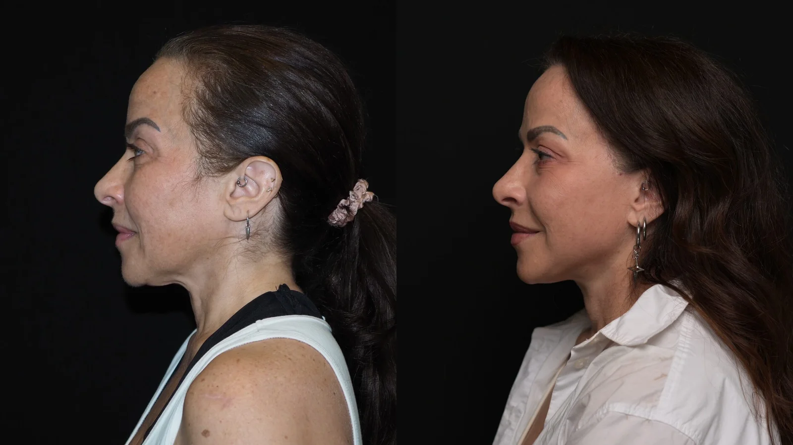Before-and-after photograph, deep plane facelift and neck lift