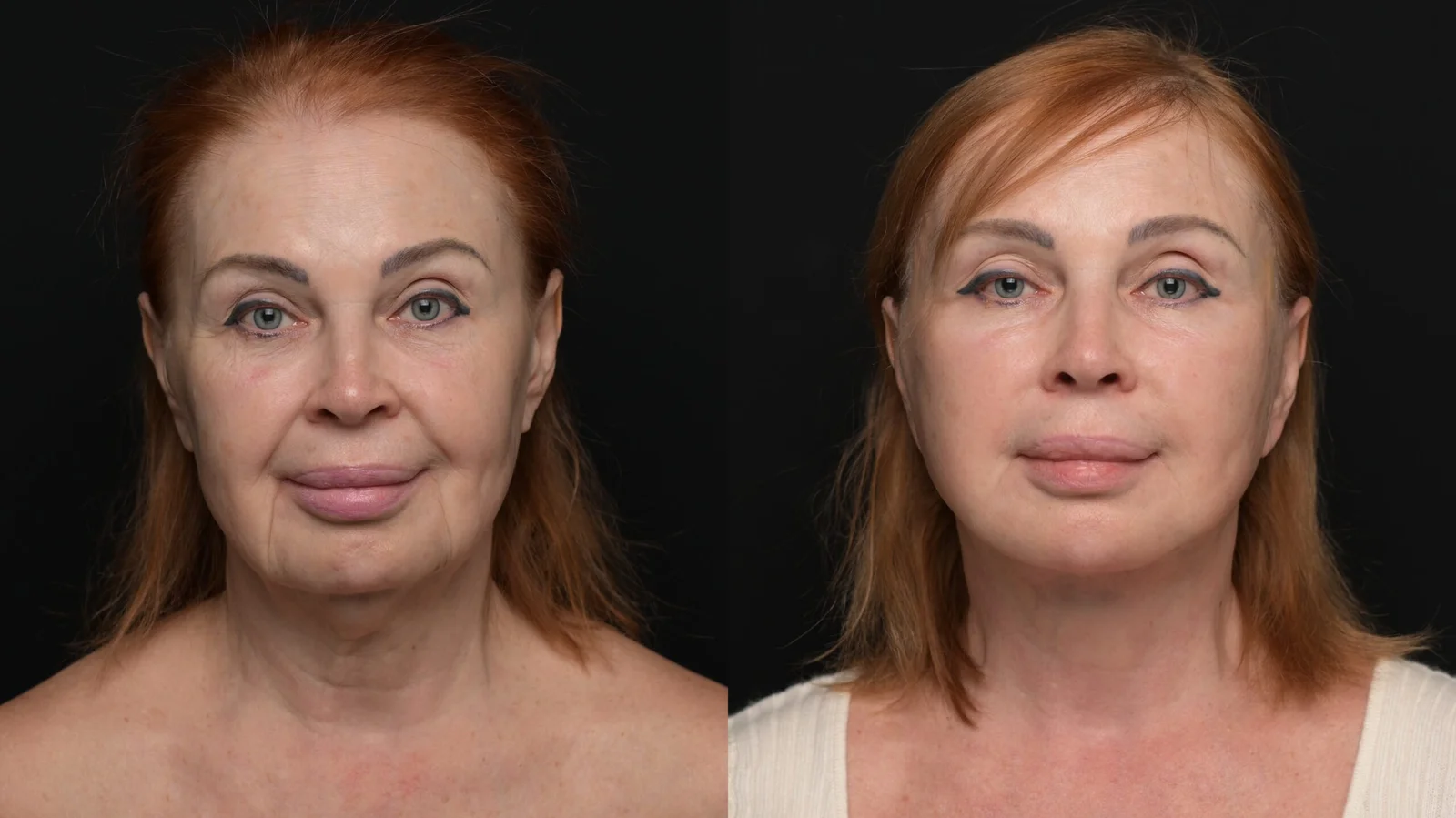 Before-and-after photograph, deep plane facelift and neck lift