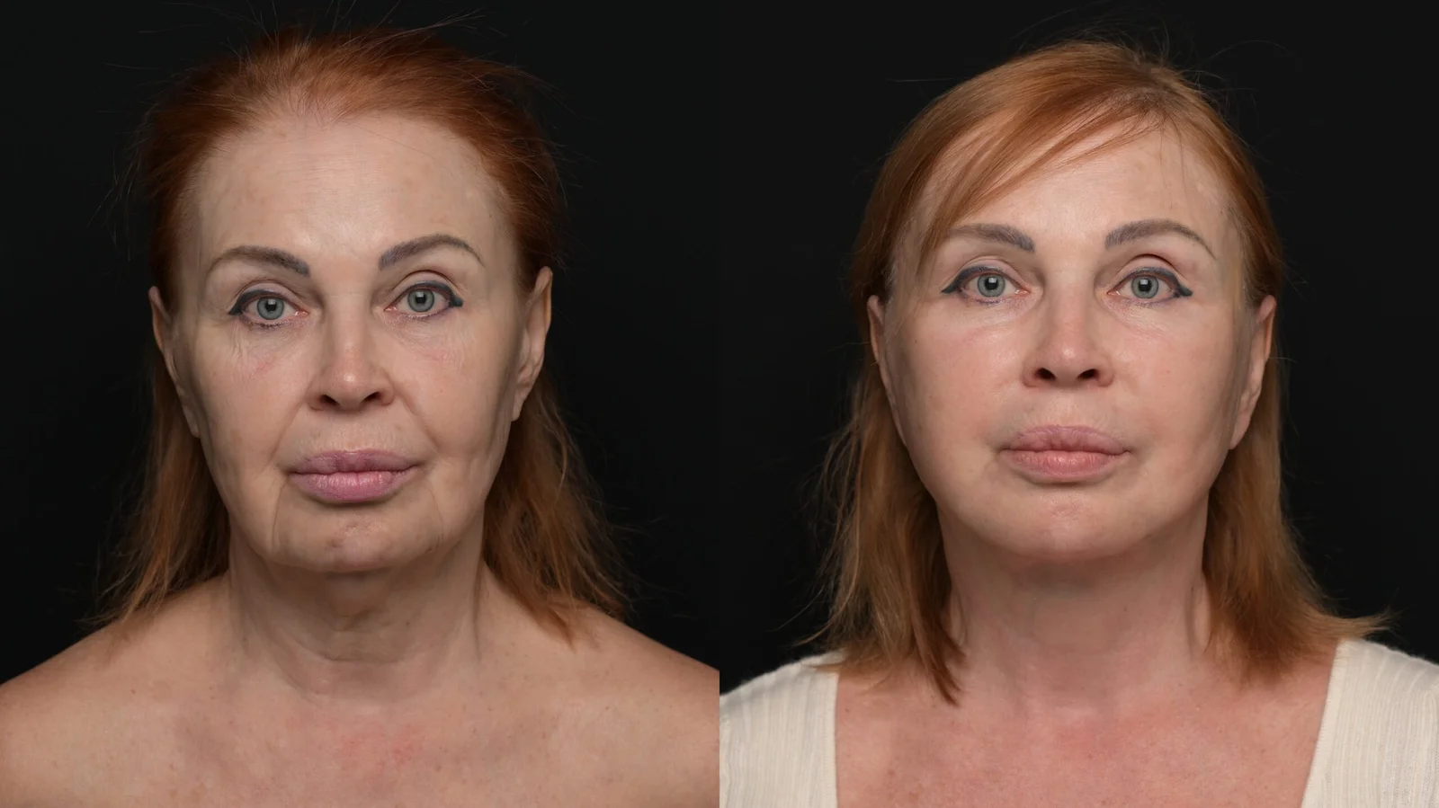 Before-and-after photograph, deep plane facelift and neck lift