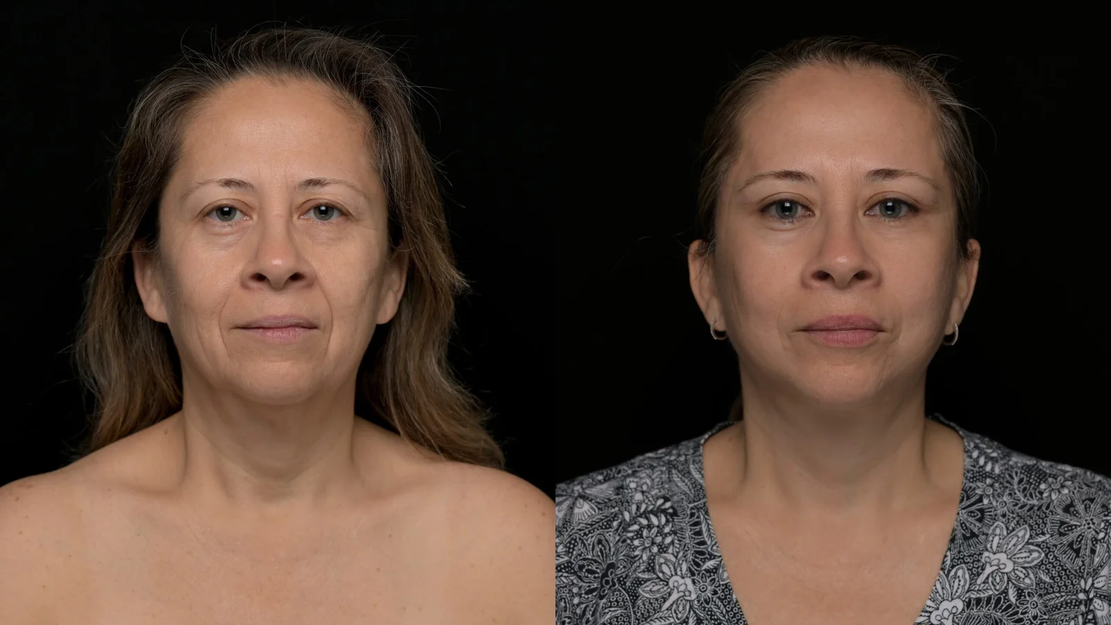 Before-and-after photograph, deep plane facelift and neck lift