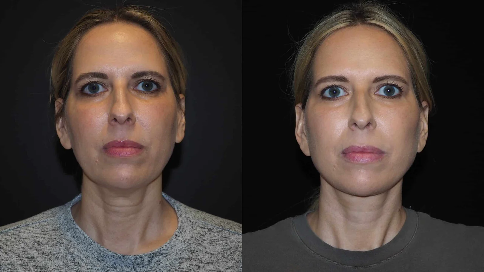 Before-and-after photograph, deep plane facelift and neck lift