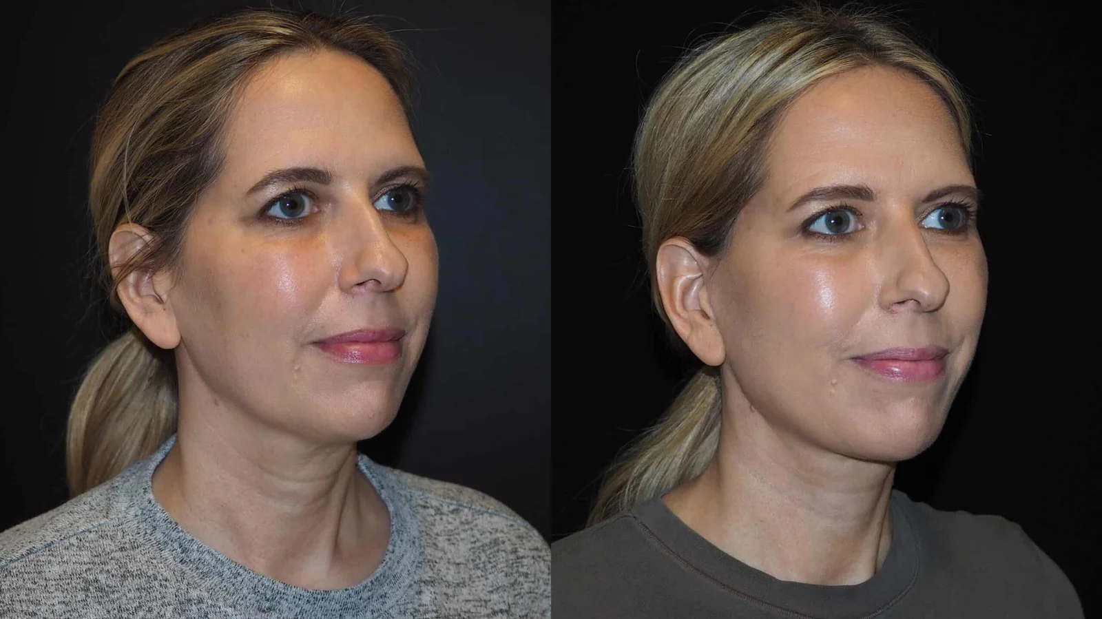 Before-and-after photograph, deep plane facelift and neck lift