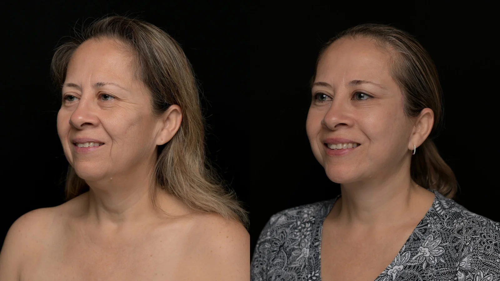 Before-and-after photograph, deep plane facelift and neck lift