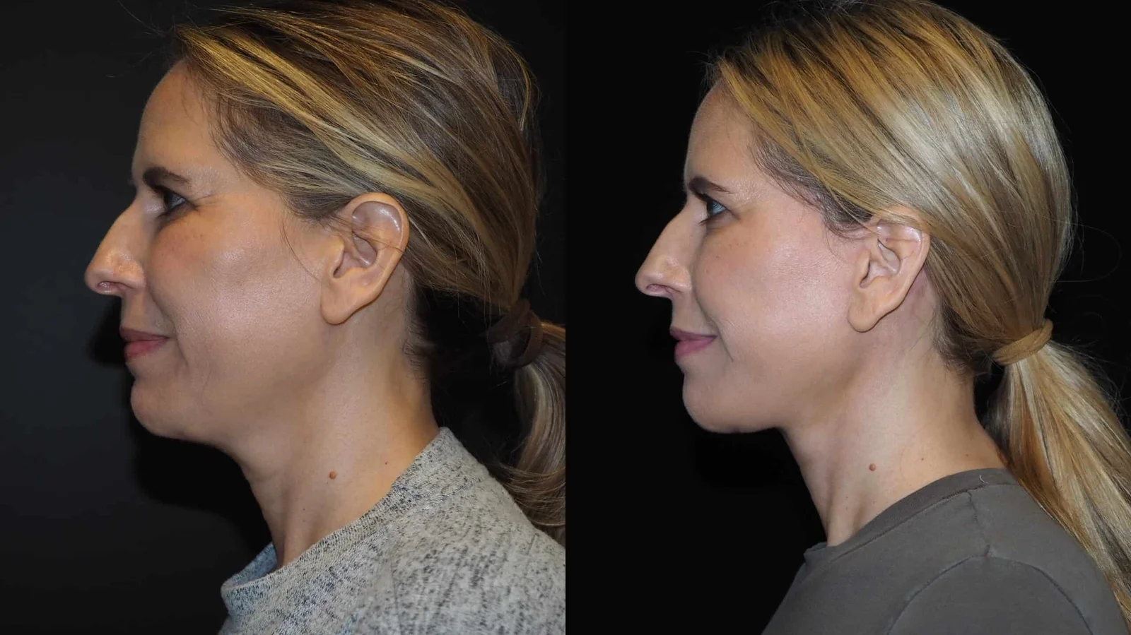 Before-and-after photograph, deep plane facelift and neck lift
