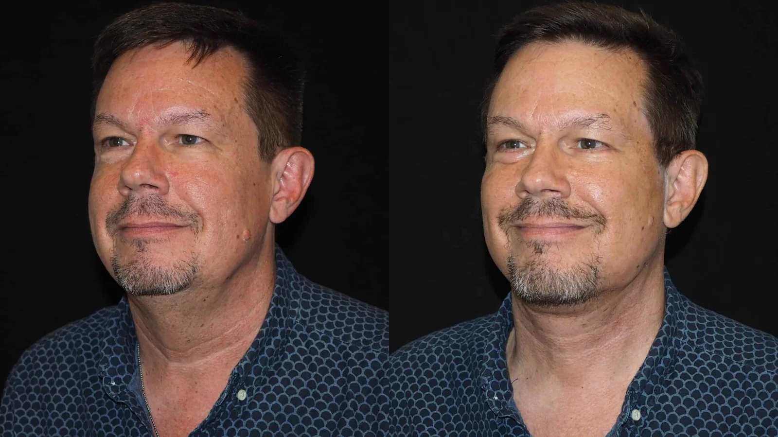 Before-and-after photograph, deep plane facelift and neck lift
