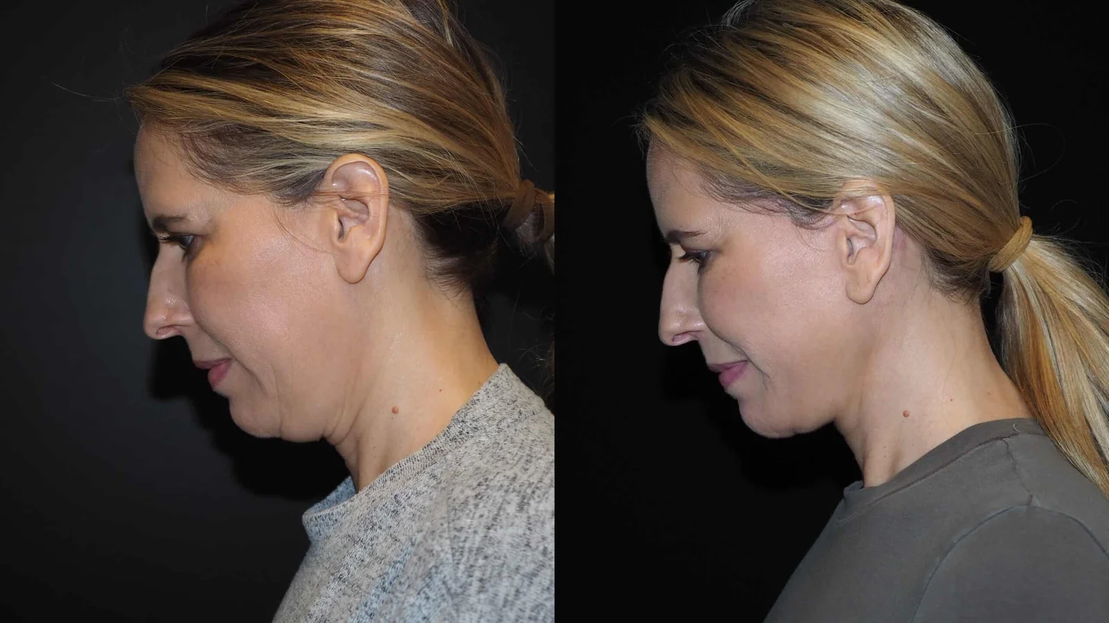 Before-and-after photograph, deep plane facelift and neck lift