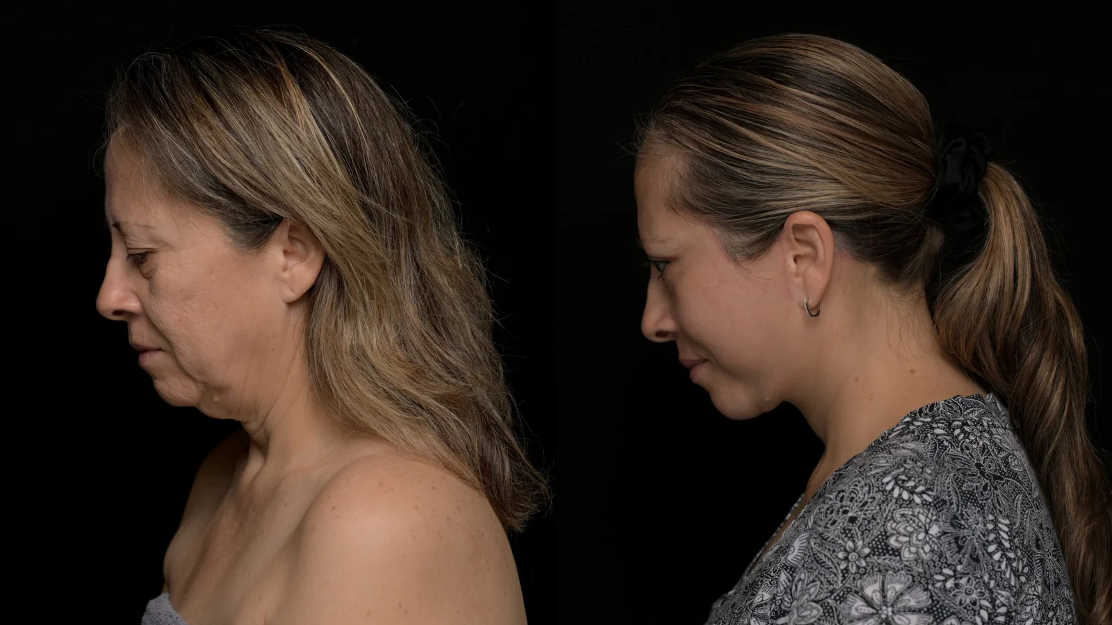 Before-and-after photograph, deep plane facelift and neck lift