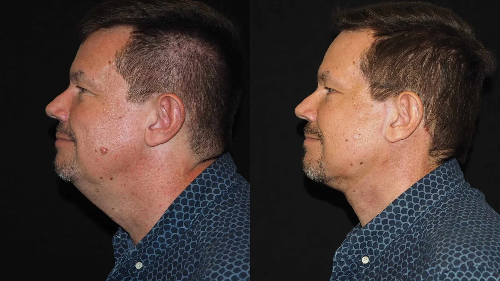 Before-and-after photograph, deep plane facelift and neck lift