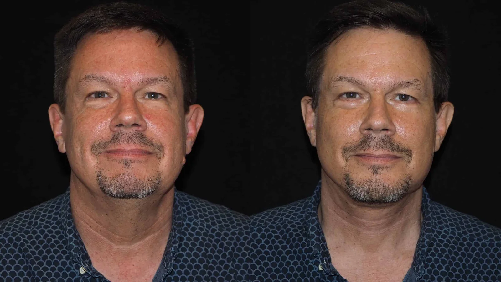 Before-and-after photograph, deep plane facelift and neck lift