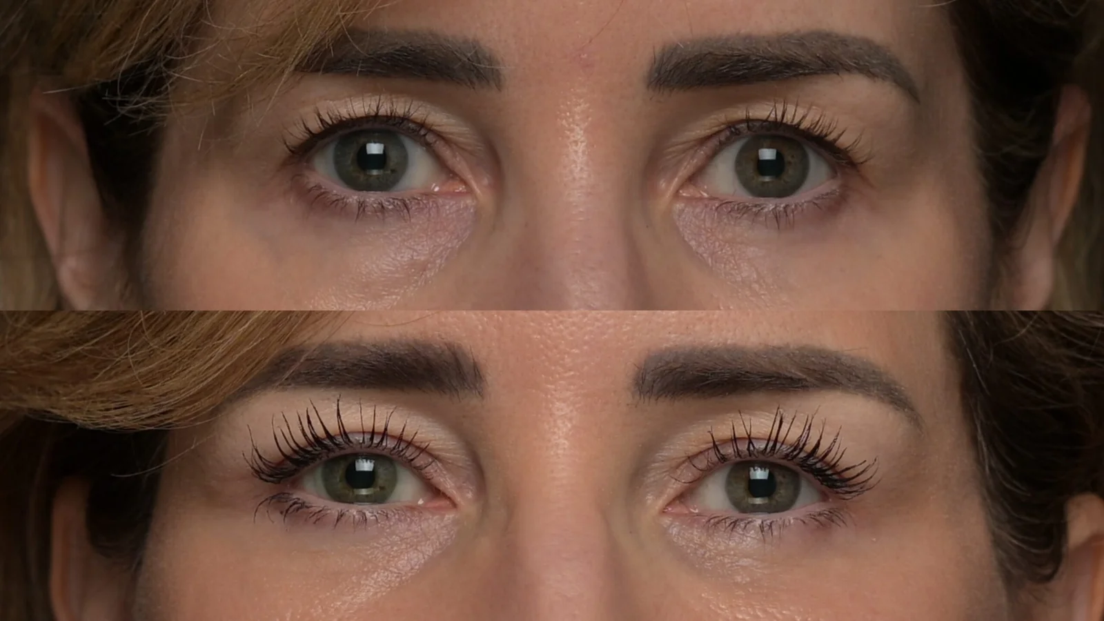 Before-and-after photograph, blepharoplasty