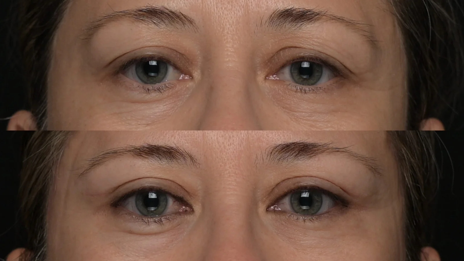 Before-and-after photograph, blepharoplasty