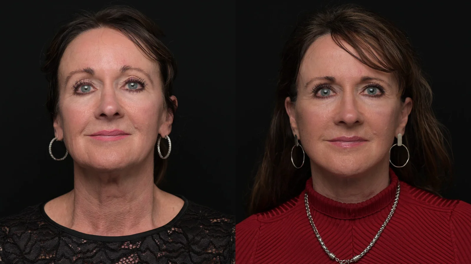 Before-and-after photograph, deep plane facelift and neck lift