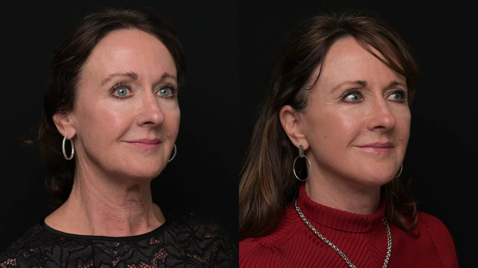Before-and-after photograph, deep plane facelift and neck lift