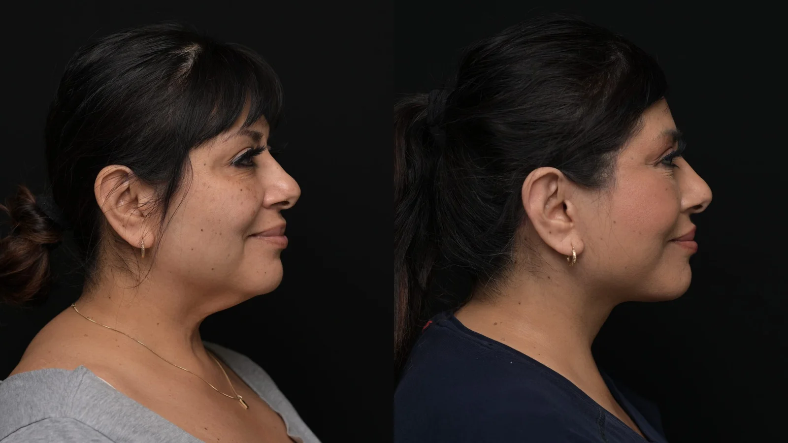 Before-and-after photograph, deep plane facelift and neck lift
