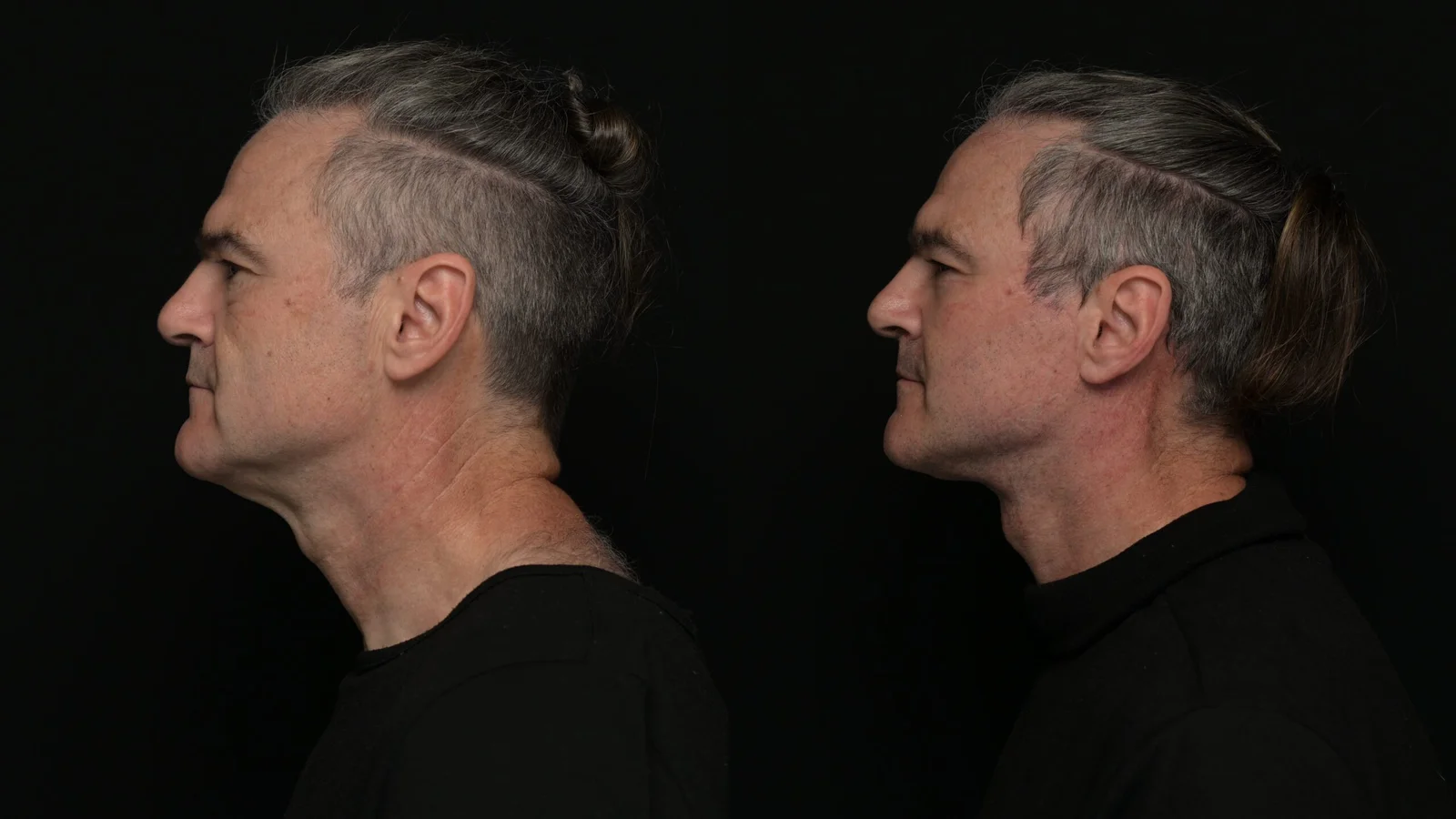 Before-and-after photograph, deep plane facelift and neck lift
