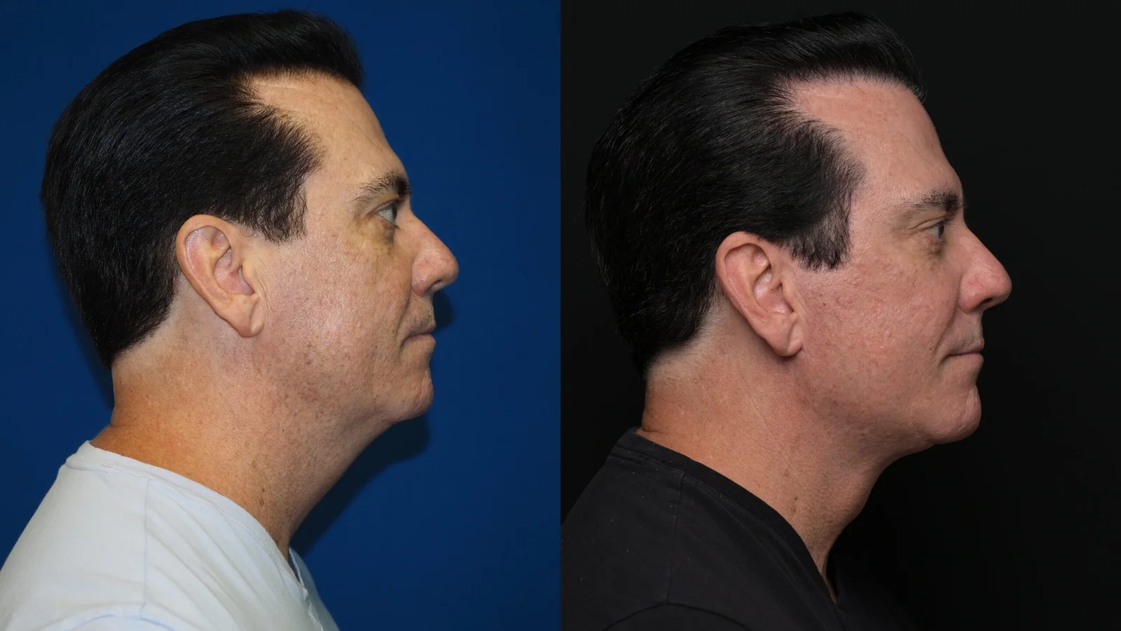 Before-and-after photograph, deep plane facelift and neck lift