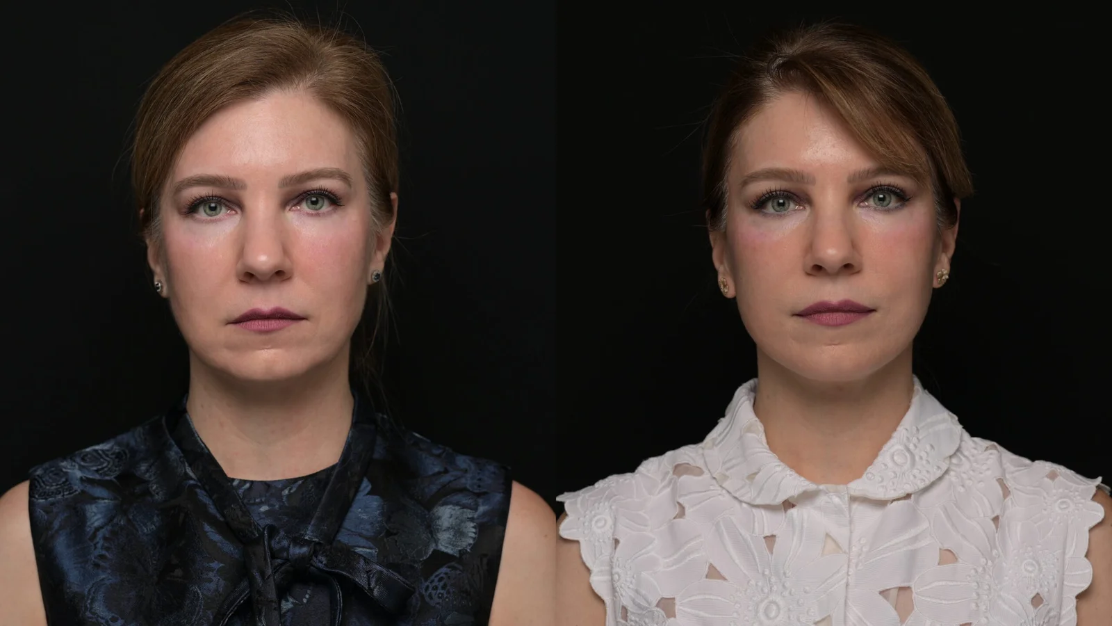 Before-and-after photograph, deep plane facelift and neck lift