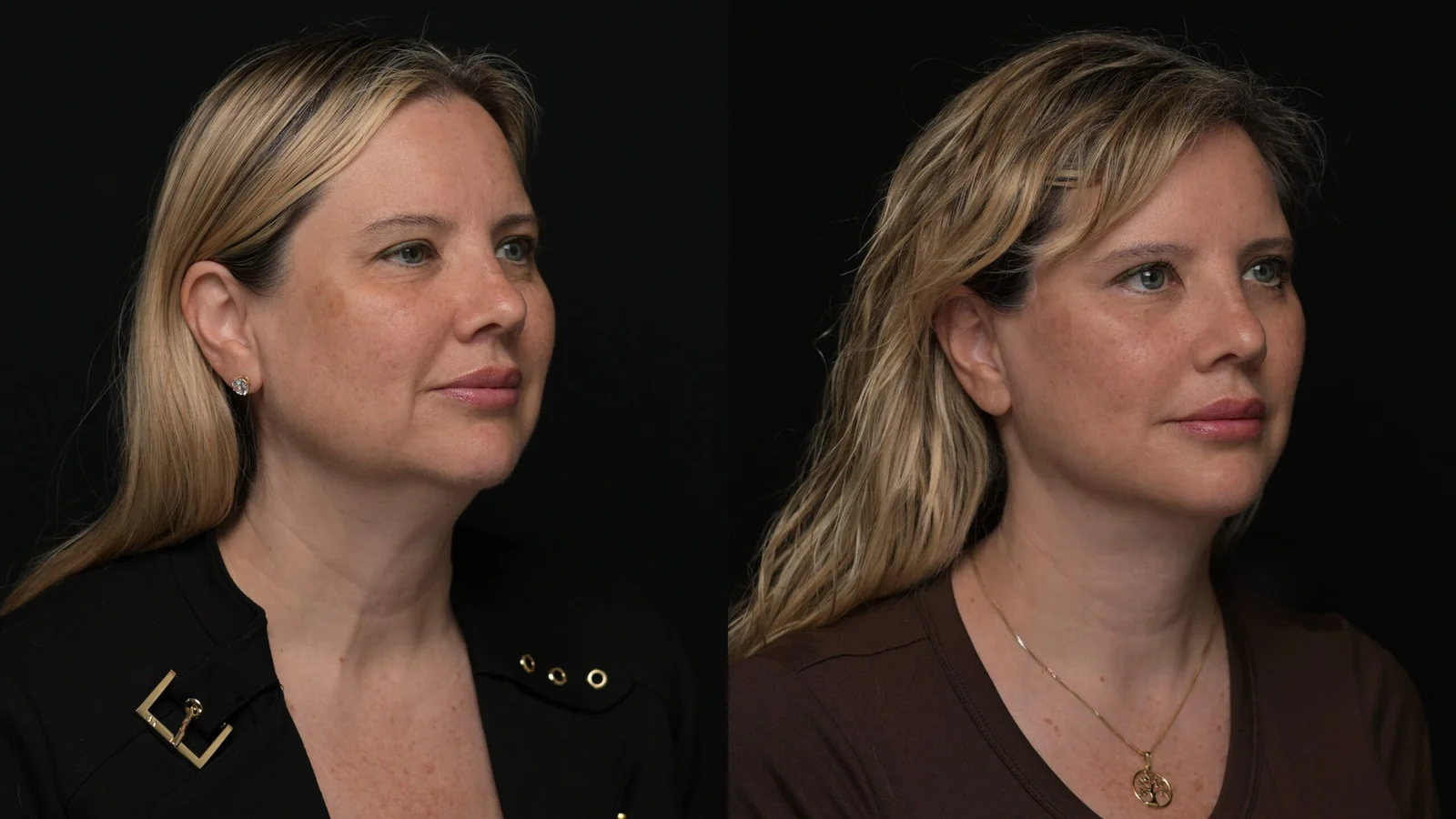 Before-and-after photograph, deep plane facelift and neck lift